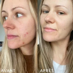 Microbiote & Peau